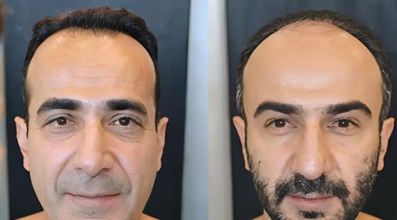 Tipps zur Auswahl des besten Haartransplantationspakets in der Türkei